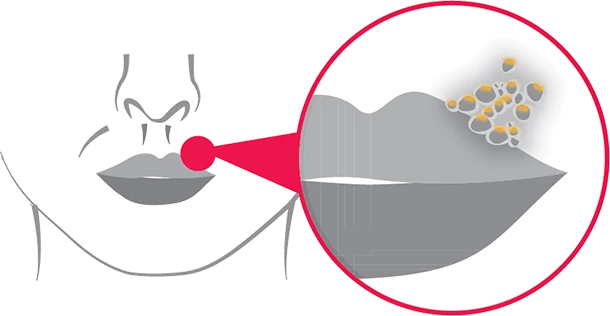 Herpesz (Fotó illlusztráció: Carbosan)