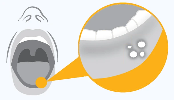 Afta (Fotó illusztráció: Carbosan)